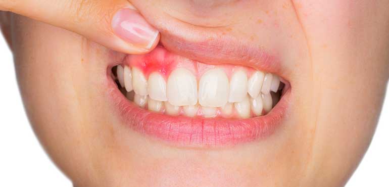 Diş Eti Hastalıkları Tedavisi Ankara Batıkent