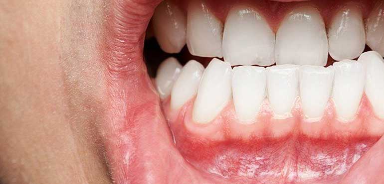 Diş Eti Hastalıkları Tedavisi Ankara Batıkent
